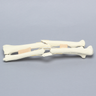 Ulna and Radius with Four-Part and Oblique Fractures, Solid Foam