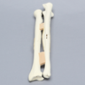 Ulna and Radius with Four-Part and Oblique Fractures, Solid Foam