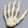 Hand with Scaphoid Fracture, Solid Foam