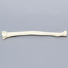 Radius, Three-Part Intra-Articular Fracture, Solid Foam