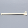 Radius, Three-Part Intra-Articular Fracture, Solid Foam