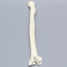 Radius, Three-Part Intra-Articular Fracture, Solid Foam
