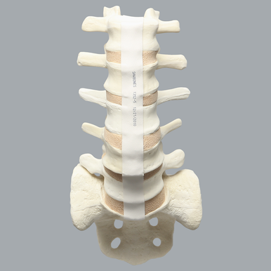 Spine, Lumbar Vertebrae with L4 Spondylolisthesis, Foam Cortical